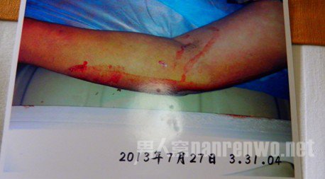 胳膊血迹 胳膊血迹