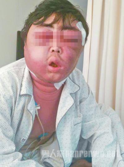男人脸肿成“球” 只因被蚊子吸食:只因义勇真男人
