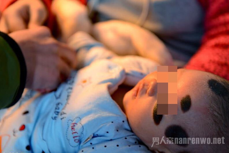 邯郸女婴患罕见巨型兽皮痣