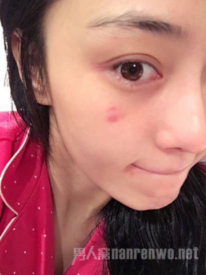 张馨予素颜痘痘抢镜