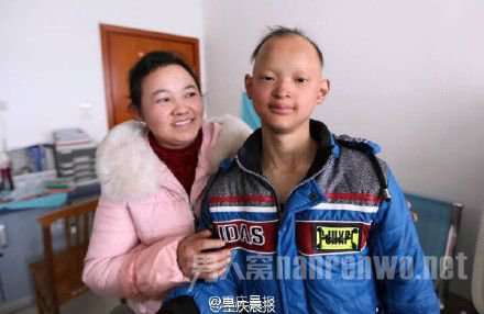少年患病似吸血鬼