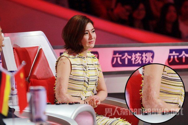 Selina上《最强大脑》胳膊伤疤触目惊心