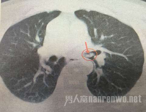 肺部有阴影