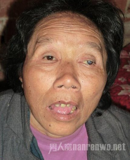 女子听信后被打256次致右眼失明