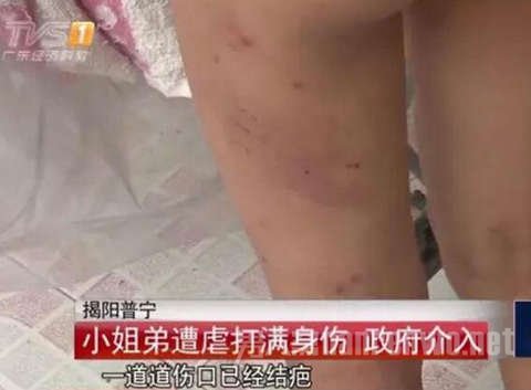 臀部淤青