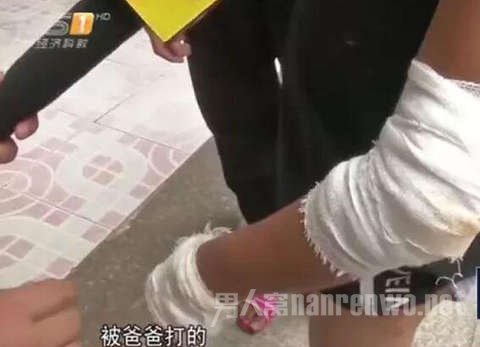 弟弟小程胳膊手臂满是伤痕