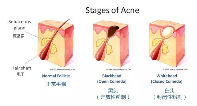 stage of acne