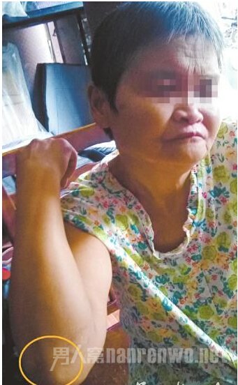 老人称在那场雨灾摔倒后其脸部、肘部、腿部多处擦伤