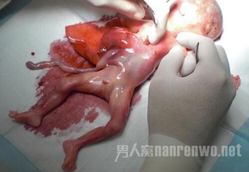 产下死婴遗弃厕所