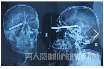 眼眶被钢签扎入