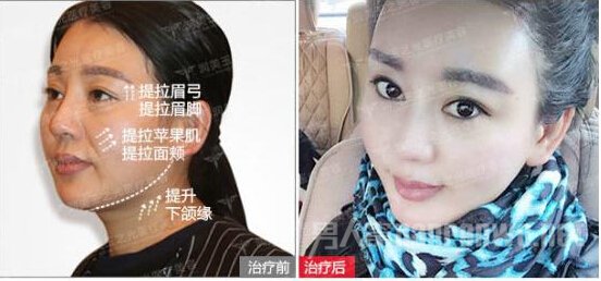 玉之光超声刀美容
