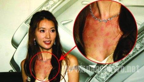 林志玲脸颊下巴红肿吓人