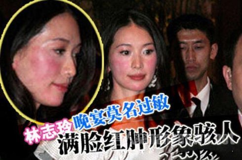 林志玲酒精过敏