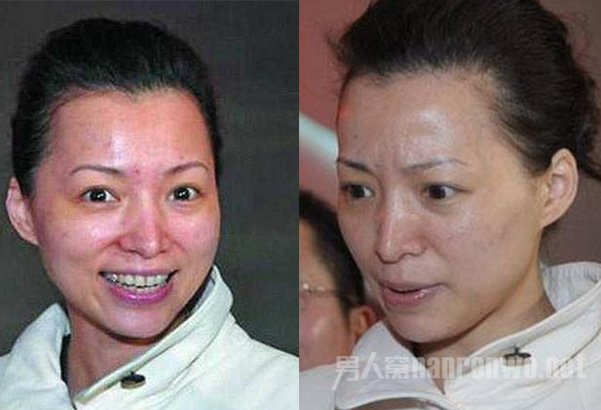 董卿满脸痘印