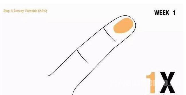 男人祛痘