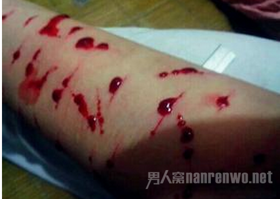 持刀自残砍手臂