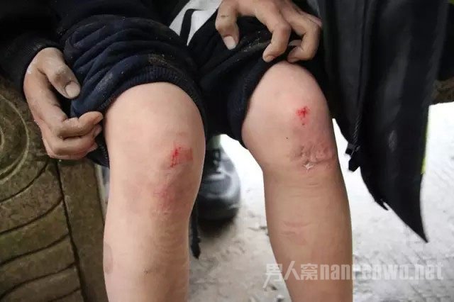 男孩被压伤的脚