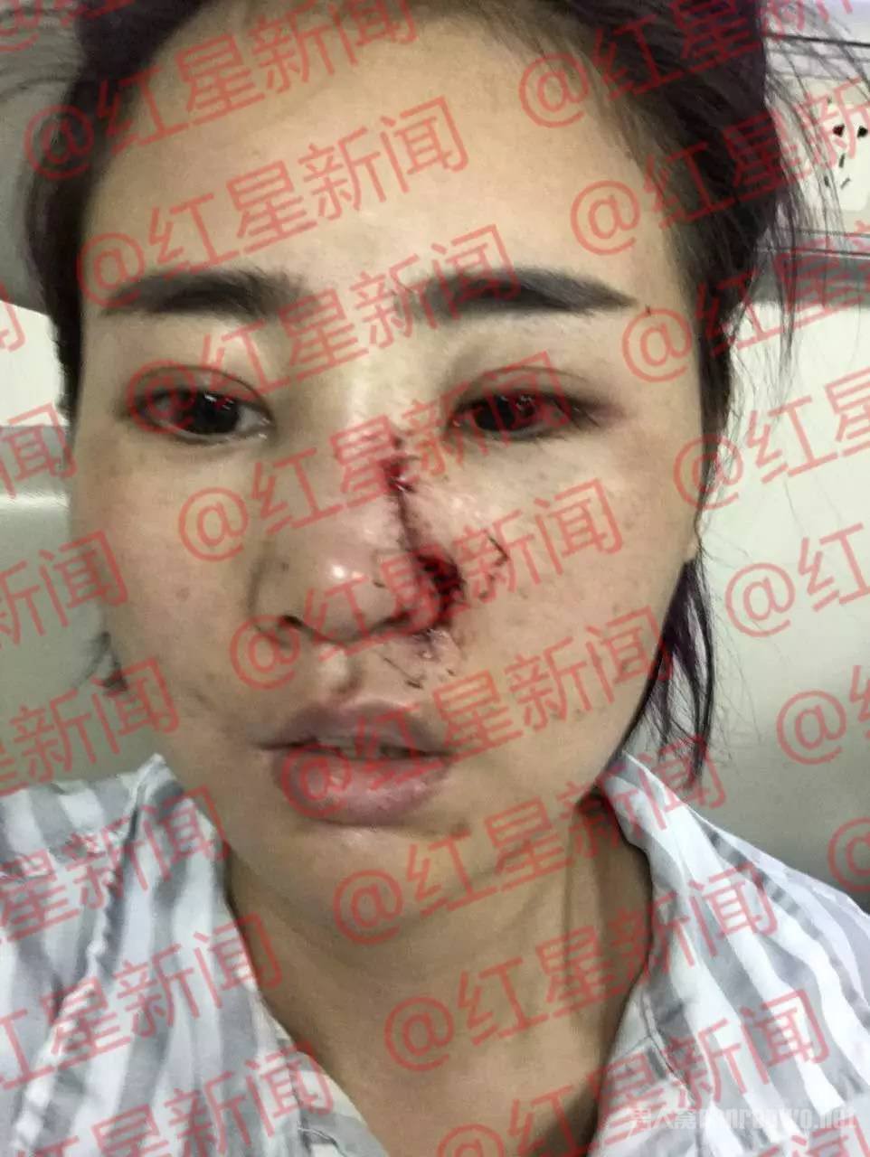 丽江被打毁容女孩公开近照