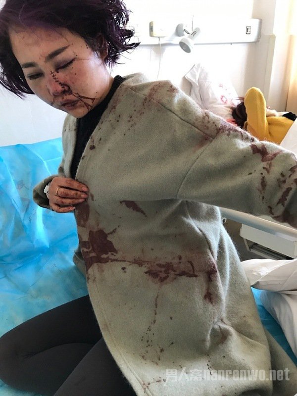 被打毁容女孩