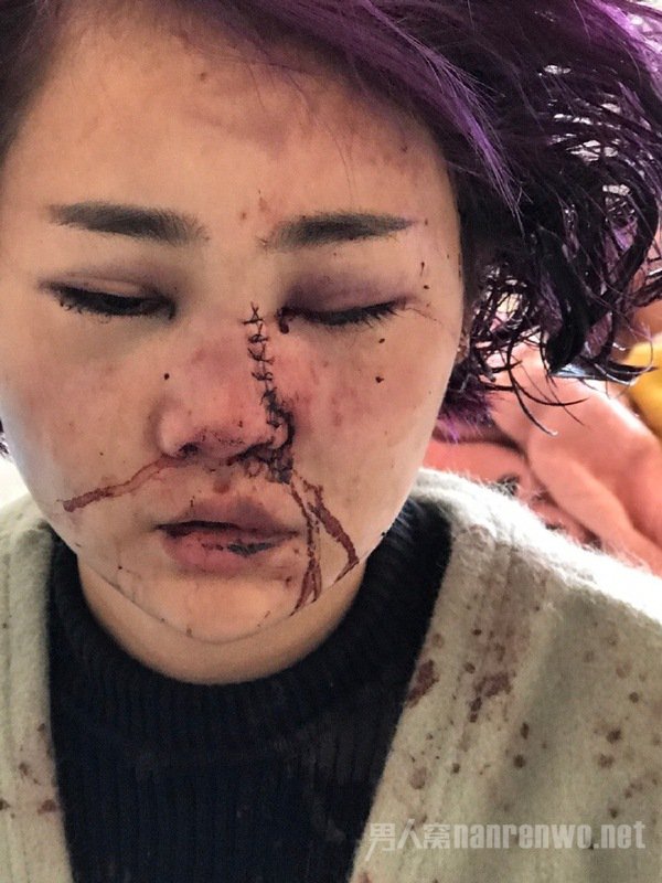 被打毁容女孩