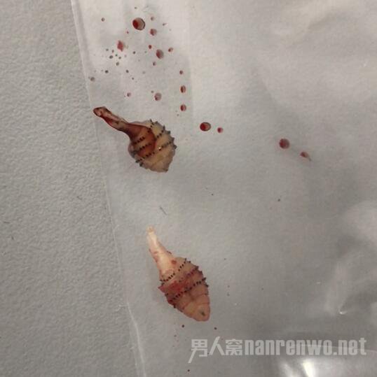 女子小腿取出两条活虫