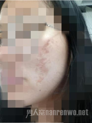 试用者脸部红肿