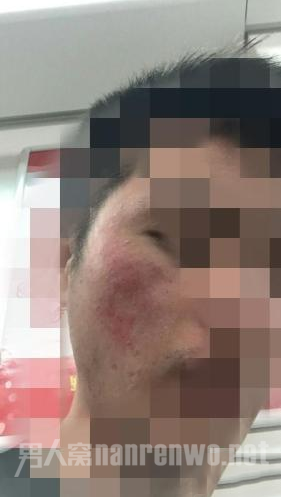 受害学生脸部出现疤块