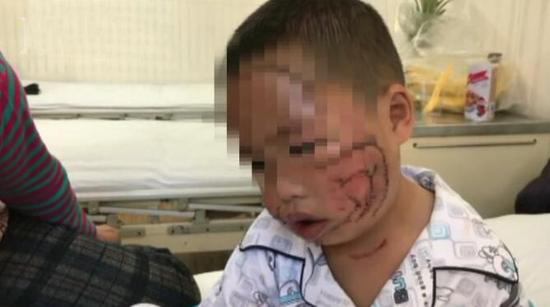 男童脸部被撕咬