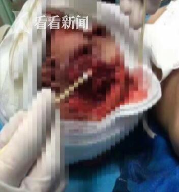 手术