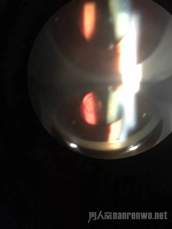 飞蚊症
