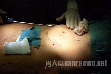 吸脂减肥手术