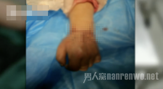女子暴怒之下砍断左手