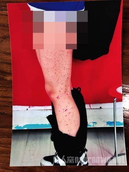女生满腿被同桌笔扎伤