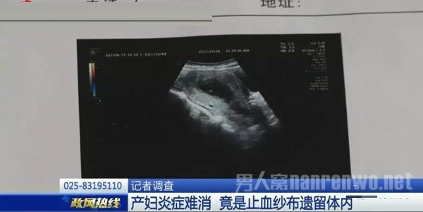 B超检查