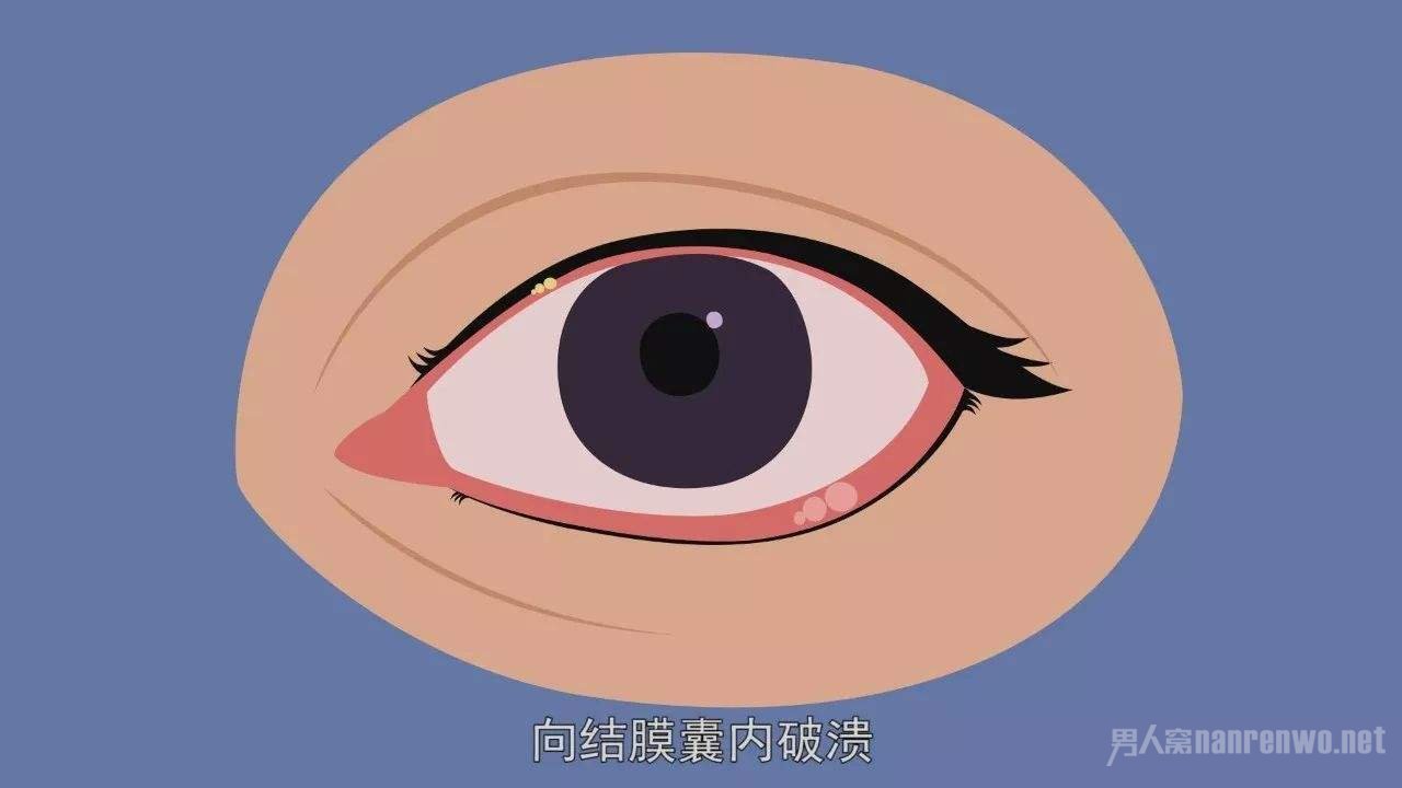 视力下降