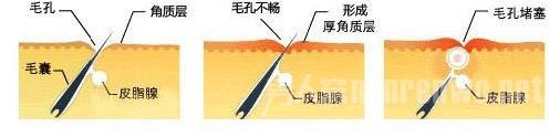 脸上长痘痘的原因
