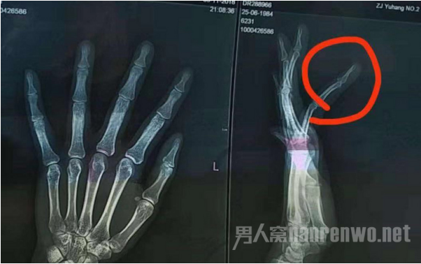 徐女士医院拍片结果