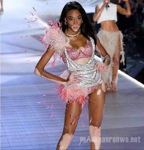 白癜风超模Winnie Harlow