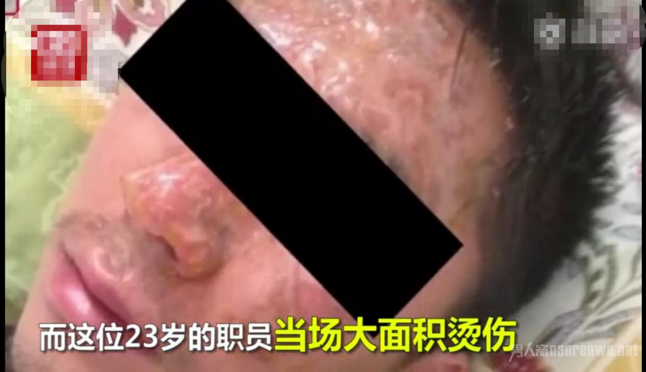 受害者被烫脸部