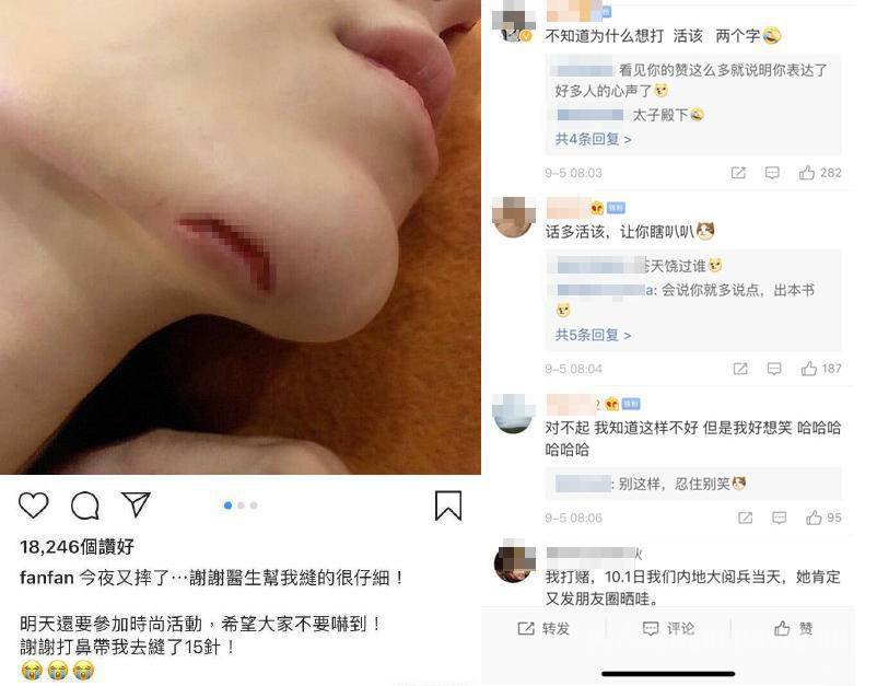 范玮琪下巴缝15针的新闻上热搜