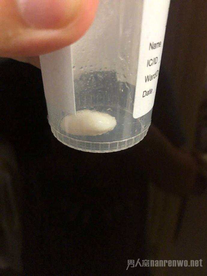 光头警官刘sir膝关节碎骨已取下