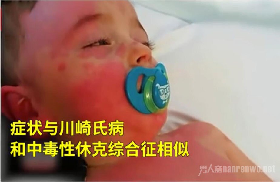 英国儿童出现罕见疾病